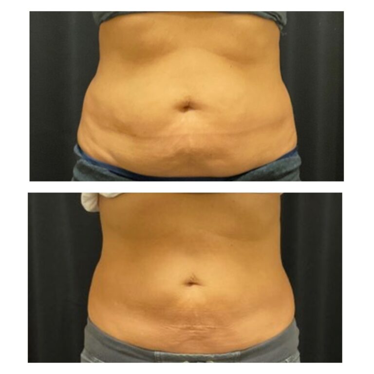 coolsculpting1