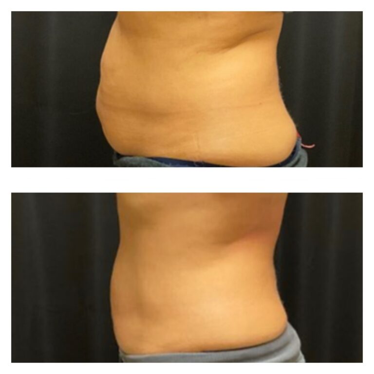 coolsculpting2