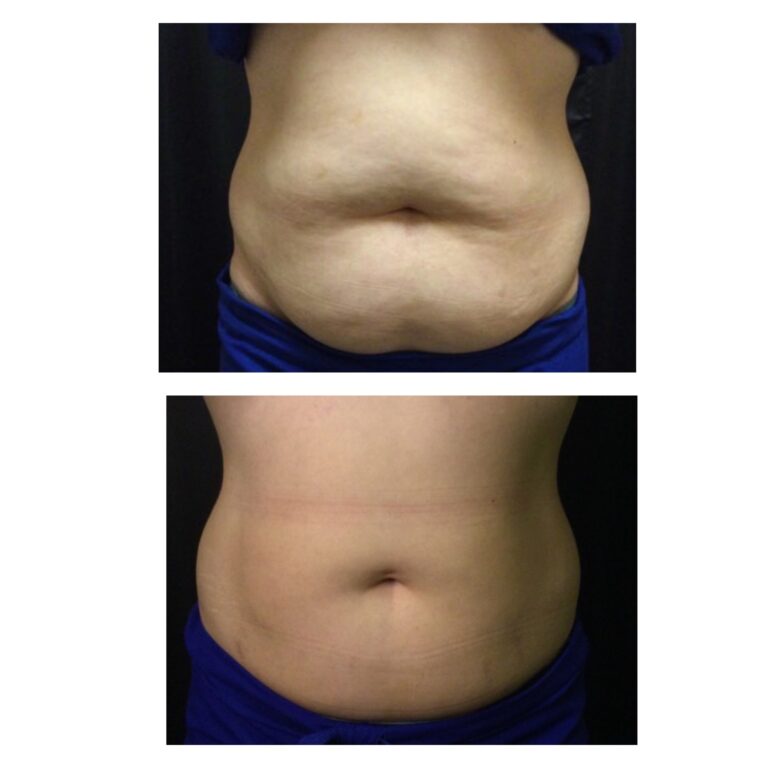 coolsculpting3