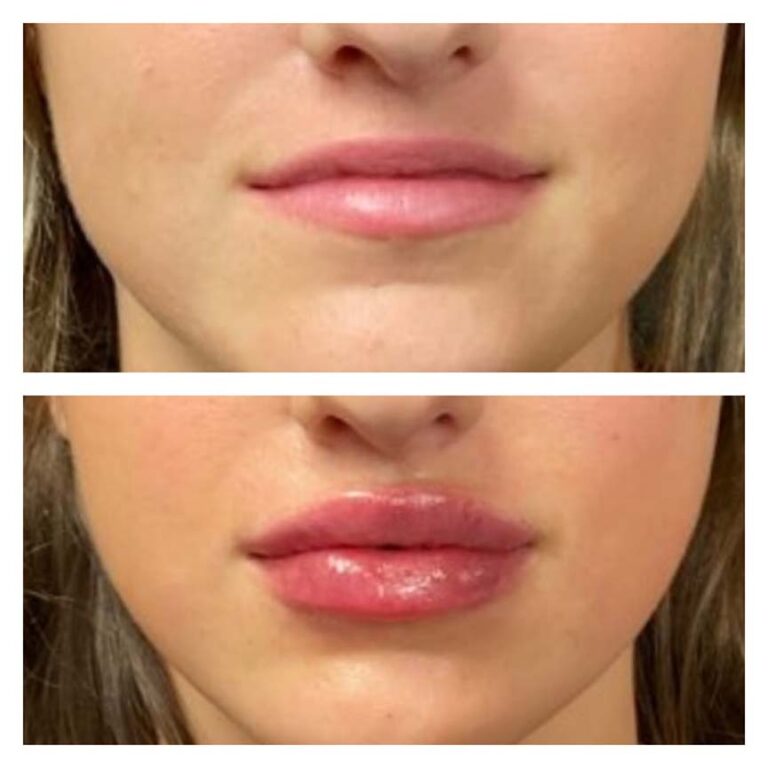 lipfiller1