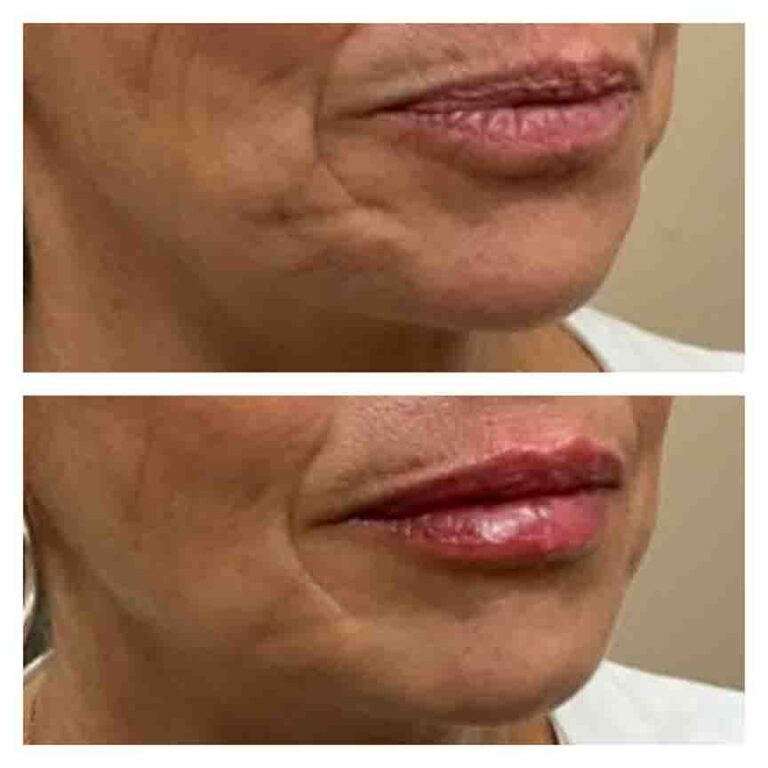 lipfiller2