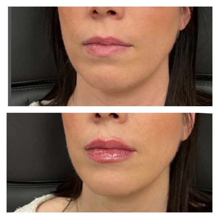 lipfiller3