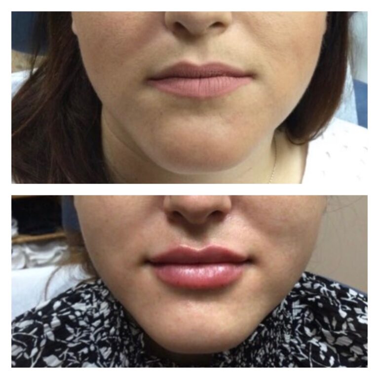 lipfilleraugmentation