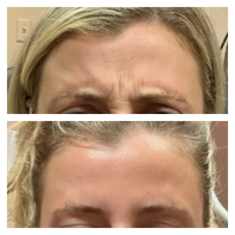 beforeandafterbotox