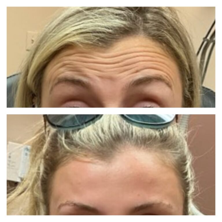 foreheadbotox