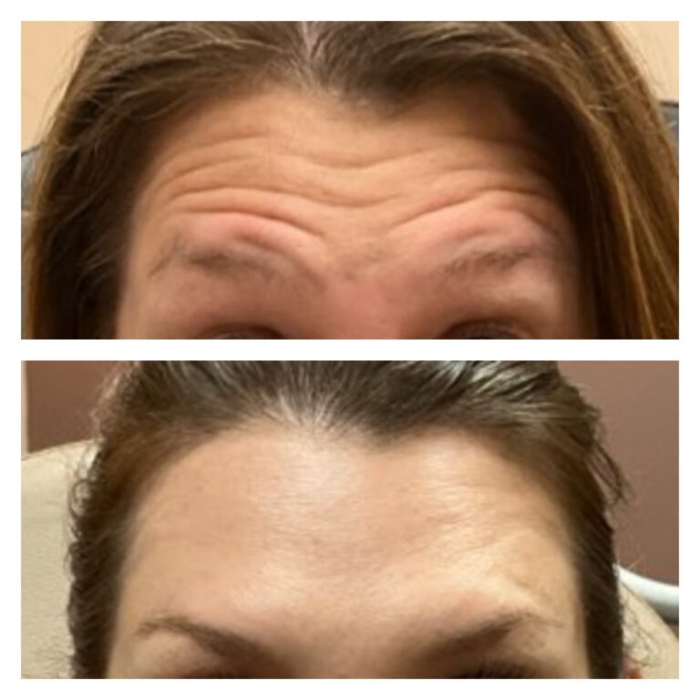 foreheadinjectionbotox