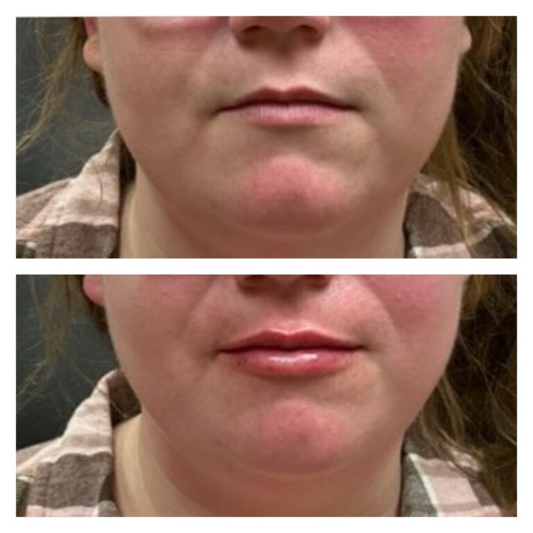 lipfiller_womanJPG