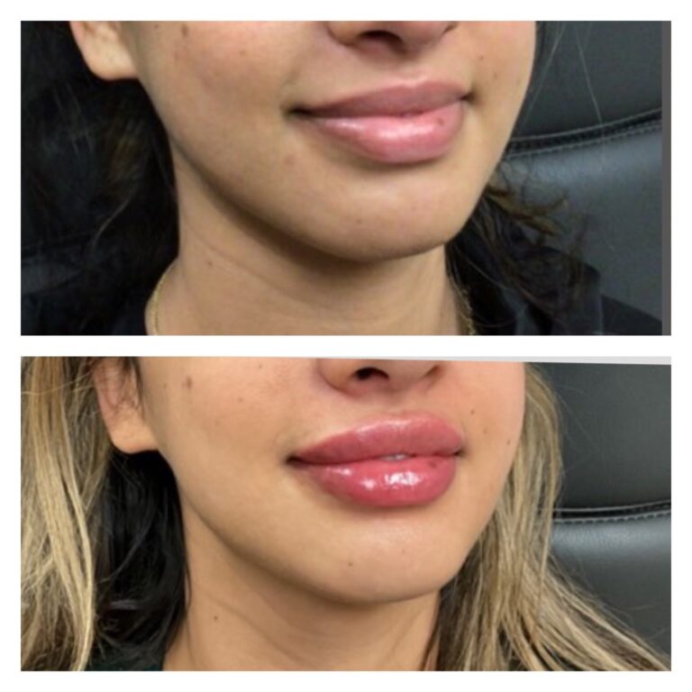 lipfillerbeforeafterside